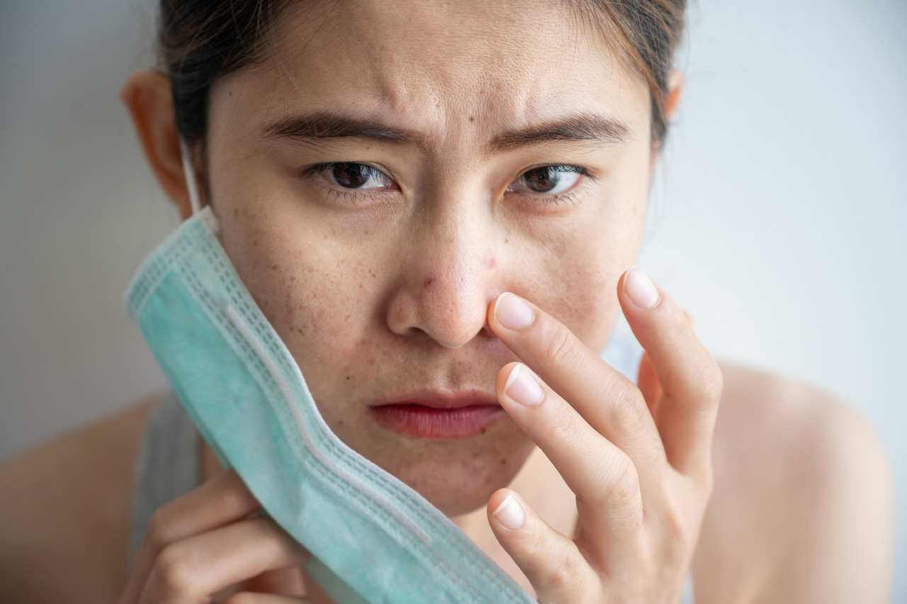 Como evitar e tratar a acne causada pelo uso de máscara de proteção