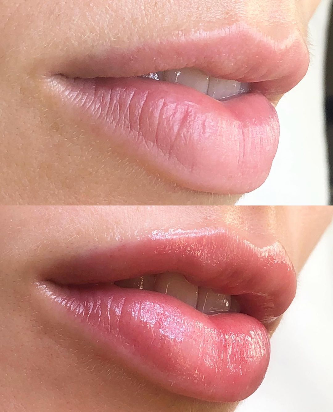 Hidralips: tudo sobre o tratamento que promove hidratação profunda nos lábios