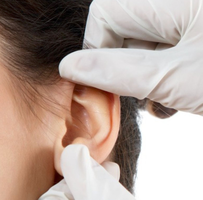 Lobuloplastia: conheça o procedimento de reparação do lóbulo da orelha